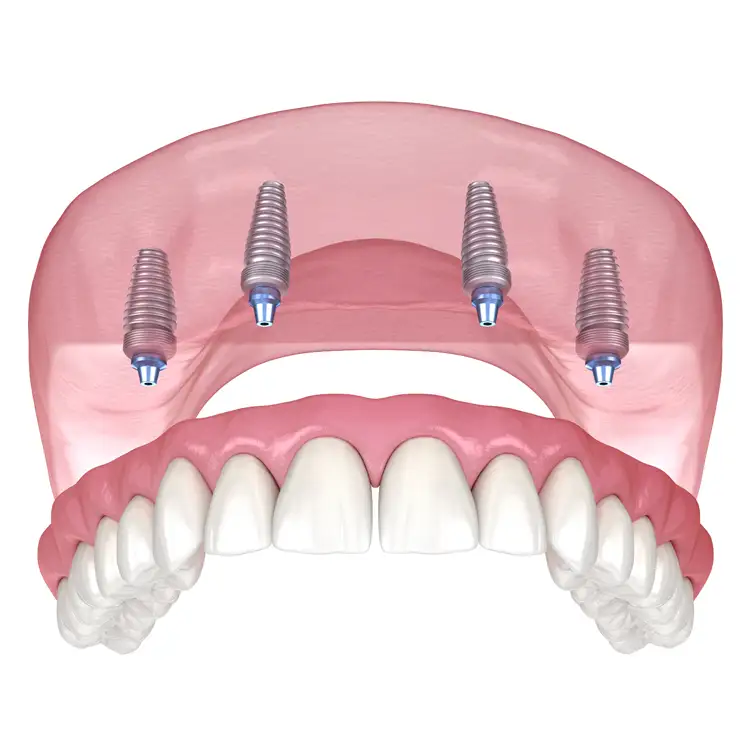 Illustration depicting the All-on-4 Denture Implant Offered at Twogether Dental in Toronto.