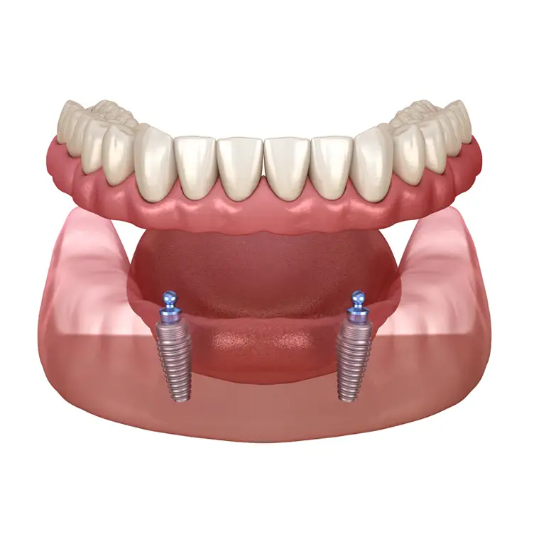 Illustration of an Implant Supported Denture