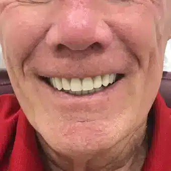 Photographic Example of a Dental Patient After Receiving Partial Upper Denture Treatment at Twogether Dentures