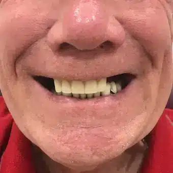 Photographic Example of a Dental Patient Before Receiving Partial Upper Denture Treatment at Twogether Dentures