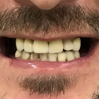 Photographic Example of a Dental Patient After Receiving Partial Upper and Lower Denture Treatment at Twogether Dentures