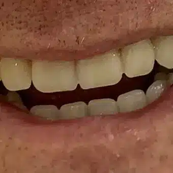 Photographic Example of a Dental Patient After Denture Treatment at Twogether Dentures