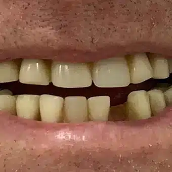 Photographic Example of a Dental Patient Before Denture Treatment at Twogether Dentures