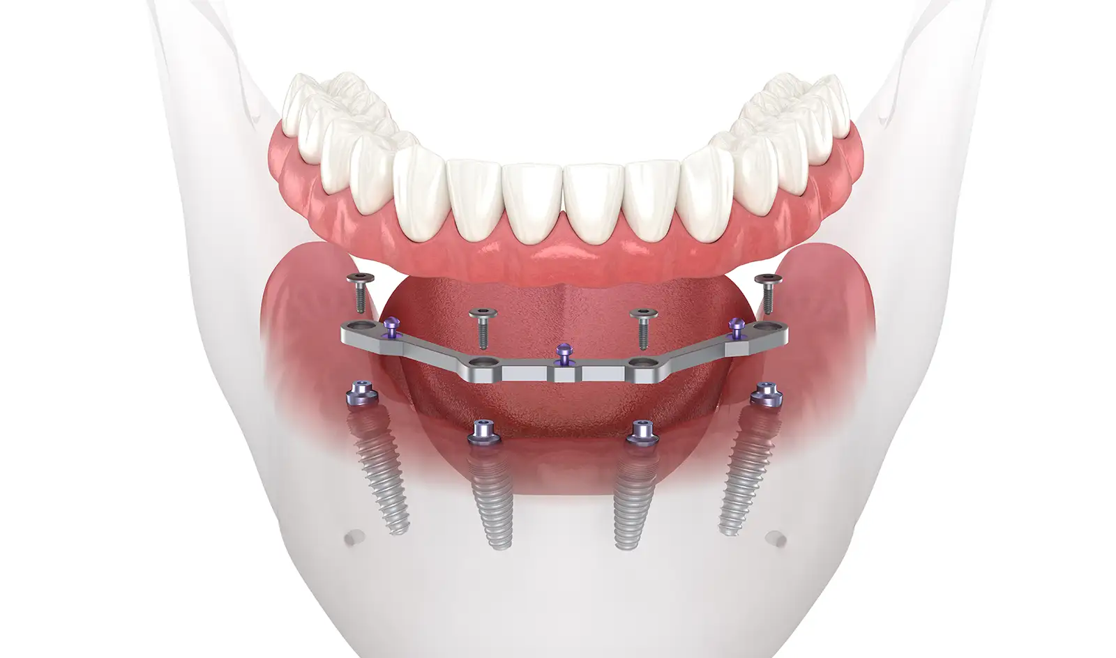 Illustration depicting the All-on-4 Implant Supported Denture System