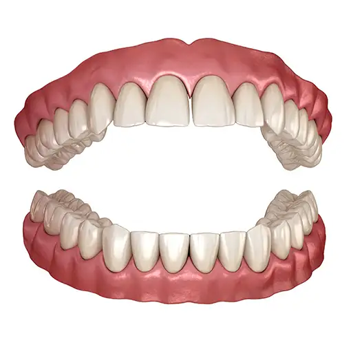 Illustration of a full arch complete denture.