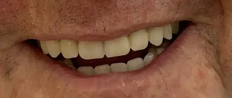 Photograph of a Patient After Dental Flipper Treatment