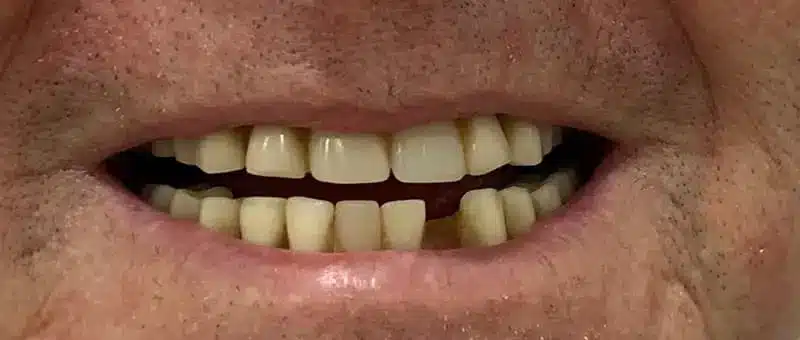 Photograph of a Patient Before Dental Flipper Treatment