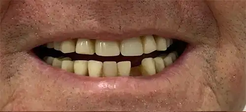 Pre-treatment photo of a patient receiving their Dental Flipper in Toronto.