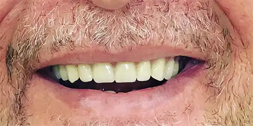 Post-treatment photo of an patient receiving complete upper denture treatment.