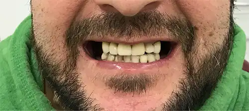 Pre-treatment photo of a patient before starting upper lower partial denture treatment in Toronto.