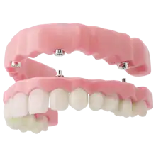 Photo example of an Implant Denture.